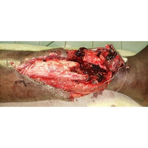 Prise en charge des fractures ouvertes de jambe au centre hospitalier régional de Tahoua.