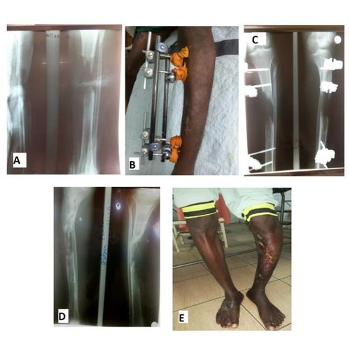 Traitement des fractures de membres par armes à feu dans un hôpital aux ressources limitées.