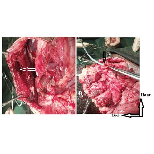 Strangulated “handlebar” hernia: two cases report and review of the literature..