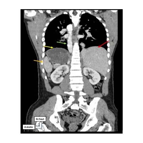 Situs inversus totalis at Niamey General Reference Hospital : a case report.