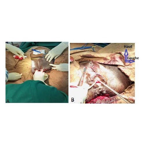 Vulvar elephantiasis. A rare complication of lymphatic filariasis. A case report from Issaka Gazobi Maternity in Niamey.