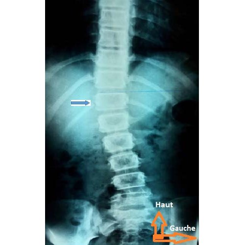 Prise en charge de la scoliose idiopathique par la rééducation fonctionnelle : à propos d'une observation.