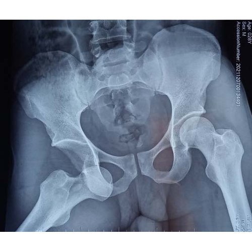 Hip obturator dislocation at Amirou Boubacar Diallo National Hospital, Niamey: case report.