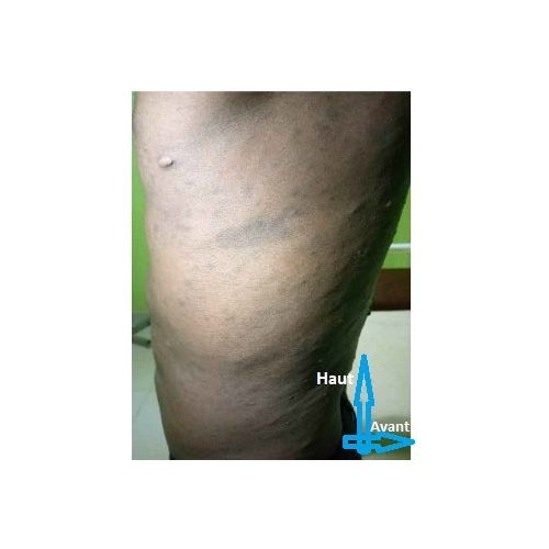 Opthalmic manifestations in neurofibromatosis type 1: a case report.