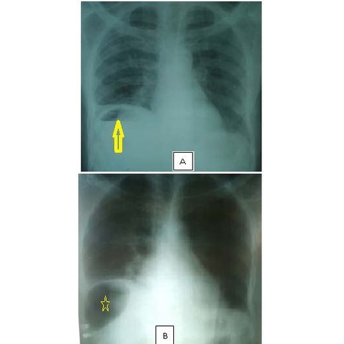 Chilaiditi’s syndrome at Zinder National Hospital: about two observations.