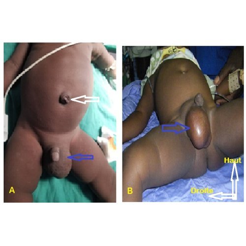 Congenital hernias of the anterior abdominal wall in children at the Niamey National hospital, Niger.