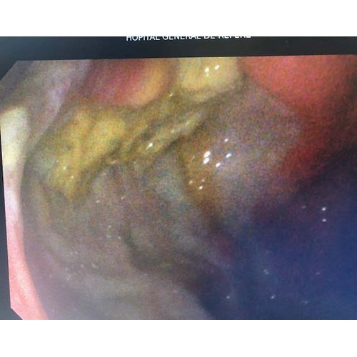 Gastric Trichobezoar revealed by Upper Gastrointestinal Haemorrhage.