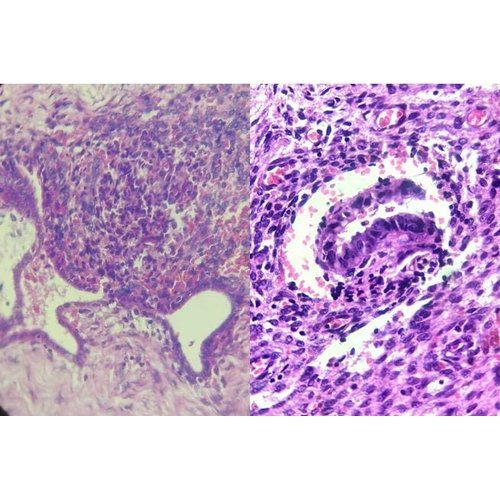 Abdominal wall endometriosis: series of 7 cases and literature review.