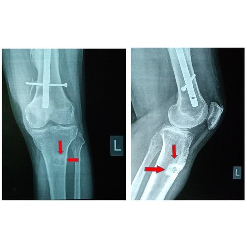 Difficulties in the management of chronic osteitis of the proximal tibia caused by multi-resistant bacteria: case report.