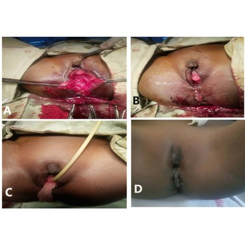 Traumatismes du périnée au cours des viols chez les enfants : à propos de 2 observations à l'Hôpital National de Niamey.