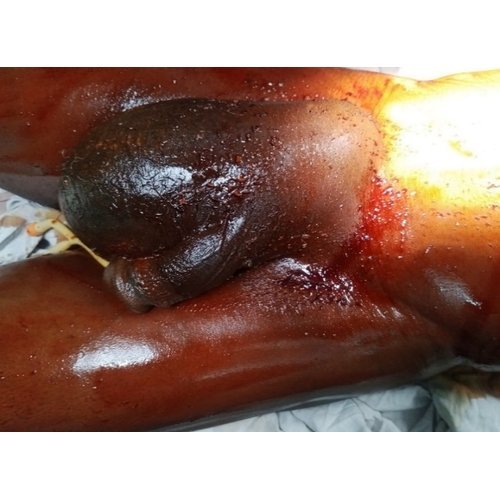 Claudius Amyand hernia: About 3 Cases at Niamey National Hospital.